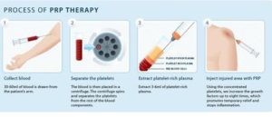 Platelet Rich Plasma therapy in Miami