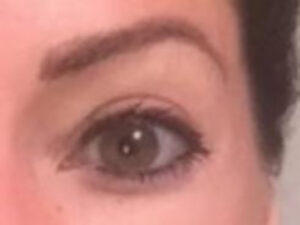 Close up After Vampire Facelift Treatment