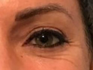 Close up Before Vampire Facelift Treatment