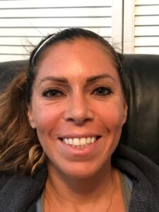 Before Vampire Facelift Treatment