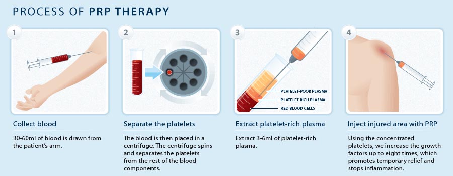 Platelet Rich Plasma Therapy in Kendall, FL